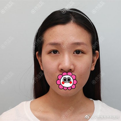 到韩国艾恩找金尹镐做了双眼皮隆鼻后气质和颜值都得到了提升