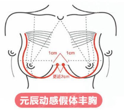 沈阳元辰曼托假体隆胸助你拥有丰满的胸部