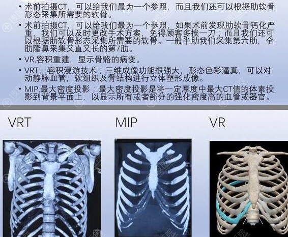 肋软骨钙化情况 肋软骨钙化情况