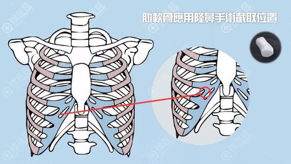 取肋软骨部位示意图 取肋软骨部位示意图