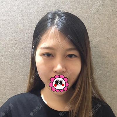 到株洲华美做双眼皮前 到株洲华美做双眼皮前