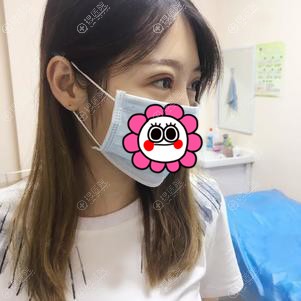 刚做完双眼皮的样子有点肿 刚做完双眼皮的样子有点肿