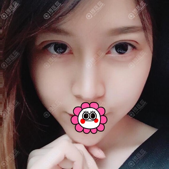 双眼皮拆线后恢复效果 双眼皮拆线后恢复效果