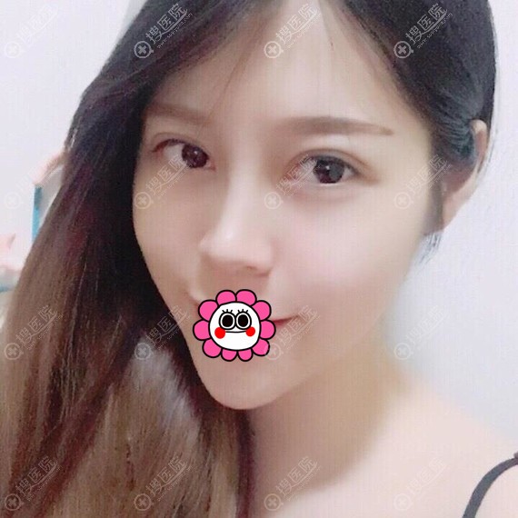 做了双眼皮感觉会更美 做了双眼皮感觉会更美