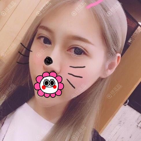 株洲华美双眼皮恢复两个月效果 株洲华美双眼皮恢复两个月效果