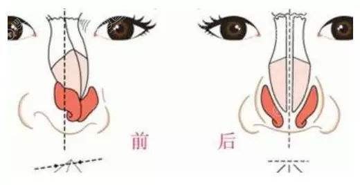 歪鼻矫正前后效果 歪鼻矫正前后效果