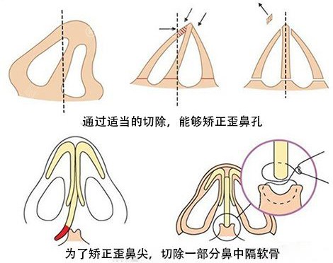 歪鼻矫正手术方法示意图 歪鼻矫正手术方法示意图
