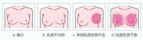 常州美莱假体隆胸让美丽“乳”此简单
