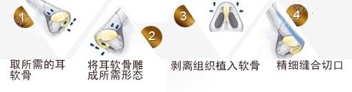 耳软骨垫鼻尖过程 耳软骨垫鼻尖过程