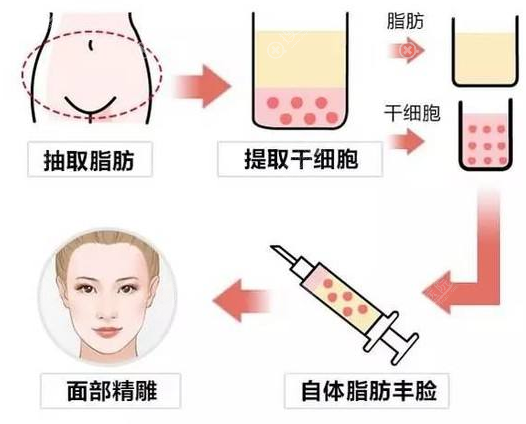 自体脂肪面部填充医院那么多,看下韩国佰诺佰琪有何独特之处?