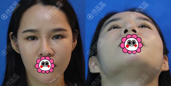 找专门做鼻子的张红艳做了鼻修复,恢复很快效果挺满意的