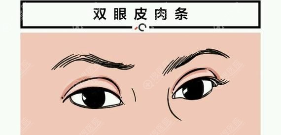 割双眼皮后为什么会出现肉条感 割双眼皮后为什么会出现肉条感