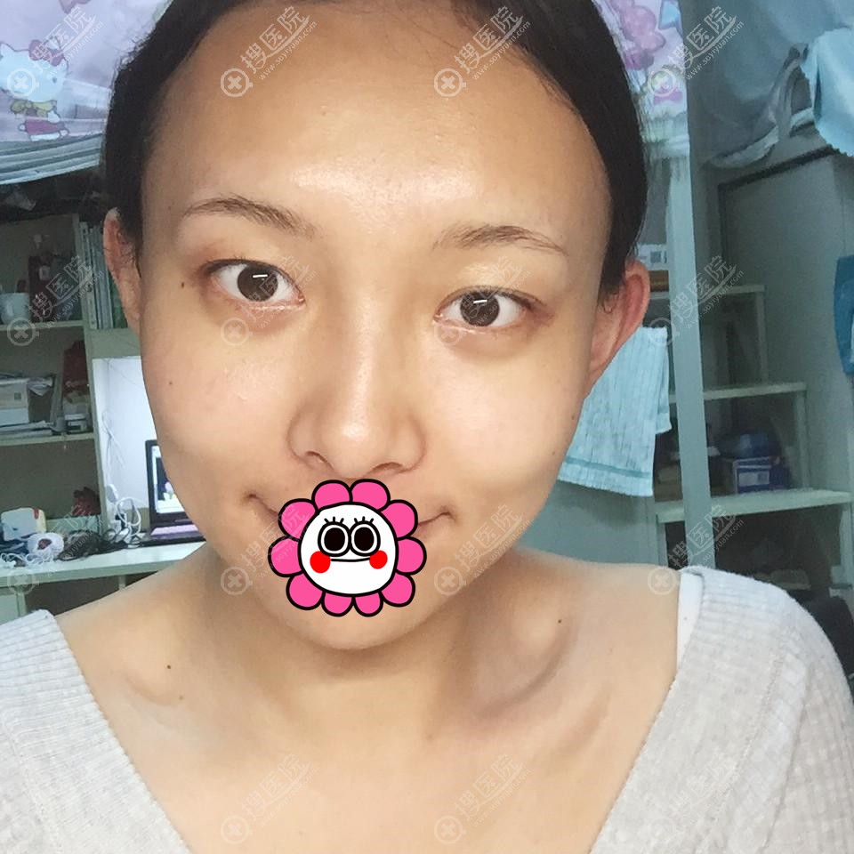 我到海口红妆尚做自体脂肪填充面部后感觉脂肪存活率挺稳定的