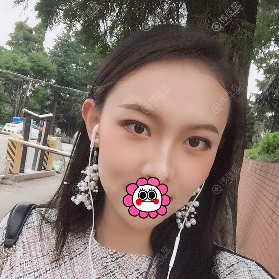 海口红妆尚自体脂肪填充面部一个月吸收的不多 海口红妆尚自体脂肪填充面部一个月吸收的不多