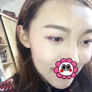 自体脂肪面部填充半个月效果 自体脂肪面部填充半个月效果