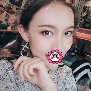 海口红妆尚关海涛自体脂肪填充面部案例 海口红妆尚关海涛自体脂肪填充面部案例