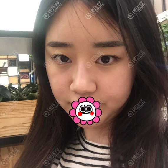 在韩国爱婷做的假体隆鼻属于自然风,恢复后有种韩国小姐姐感觉
