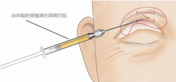 眼睑脂肪去除过多造成的眼窝凹陷可以通过填充的方式 眼睑脂肪去除过多造成的眼窝凹陷可以通过填充的方式