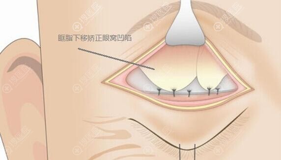 双眼皮修复手术改善眼窝凹陷 双眼皮修复手术改善眼窝凹陷