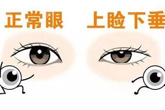 如何判断是不是上睑下垂 如何判断是不是上睑下垂