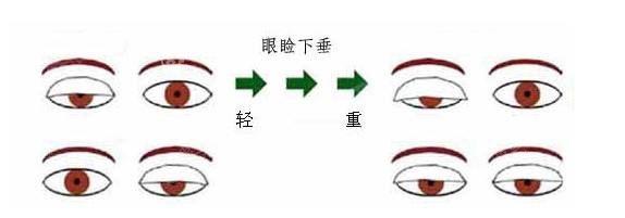 什么是上睑下垂? 什么是上睑下垂?