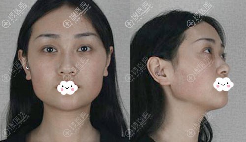 成都的宝宝们看过来,做磨颧骨手术要经历的痛你们知道吗?