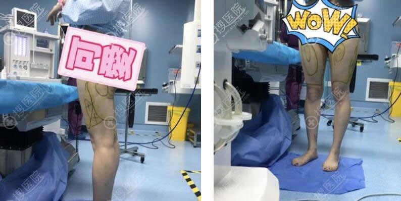 没想到在南京美莱做大腿吸脂7个多月腿型变成这样啦!