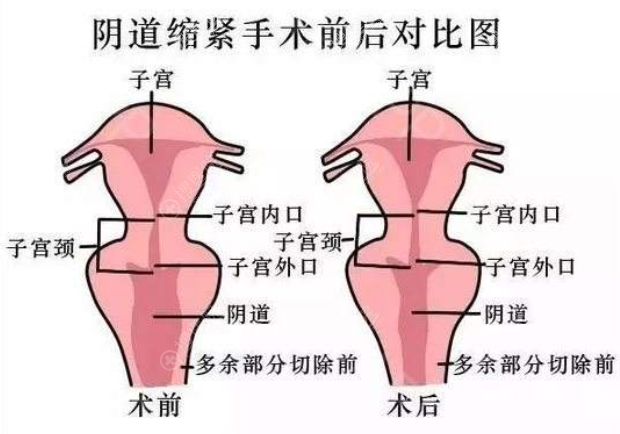 阴道紧缩手术前后效果模拟对比图 阴道紧缩手术前后效果模拟对比图