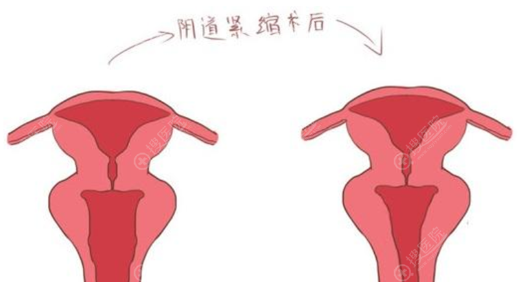 阴道紧缩前后效果对比示意图 阴道紧缩前后效果对比示意图