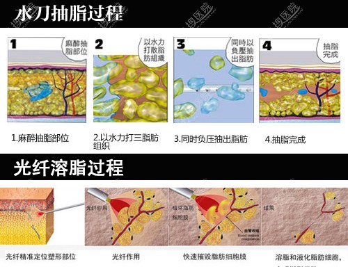 光纤溶脂和水动力吸脂过程图 光纤溶脂和水动力吸脂过程图