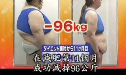 腹壁整形术VS腹壁吸脂,原来肚皮松弛选对方法很重要!