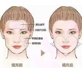 这是我在贵阳做的自体脂肪填充面部恢复效果,一点都不显假