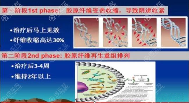 德国FOTONA饵激光缩阴效果怎么样? 德国FOTONA饵激光缩阴效果怎么样?