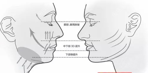 面部埋线提升原理 面部埋线提升原理