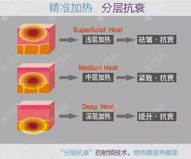 热拉提分层抗衰技术 热拉提分层抗衰技术