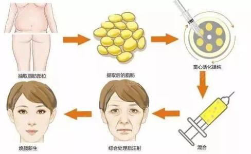 自体脂肪面部填充流程图 自体脂肪面部填充流程图