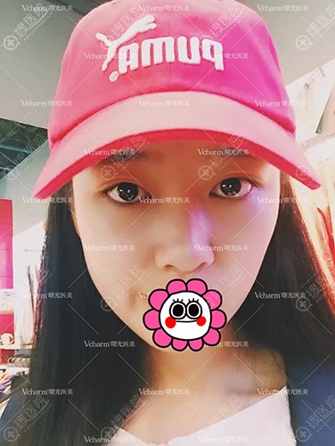 带你体验嘉兴曙光做的埃菲尔鼻综合,感受由内而外的个性美鼻