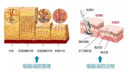 吸脂减肥原理 吸脂减肥原理