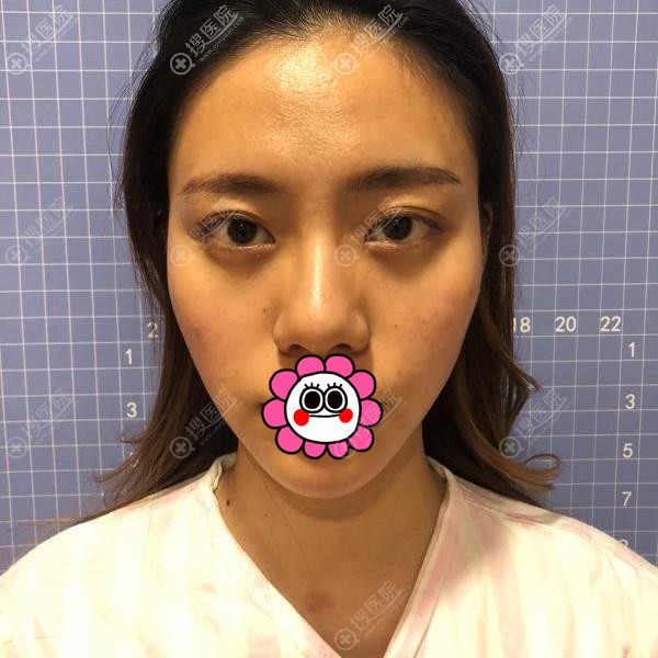 面部凹陷显老气,变年轻的秘诀就是到苏州康美做面部脂肪填充
