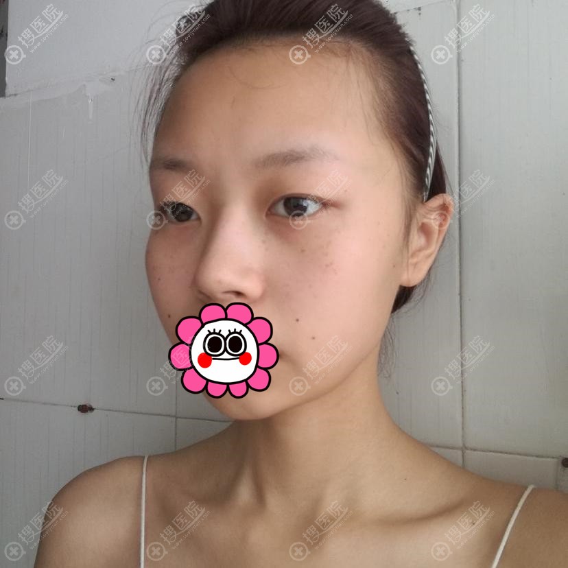 在无锡同舟做面部脂肪填充花了一万多,一个月恢复自然觉着很值