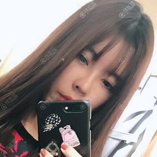 做自体脂肪填充面部一个月 做自体脂肪填充面部一个月