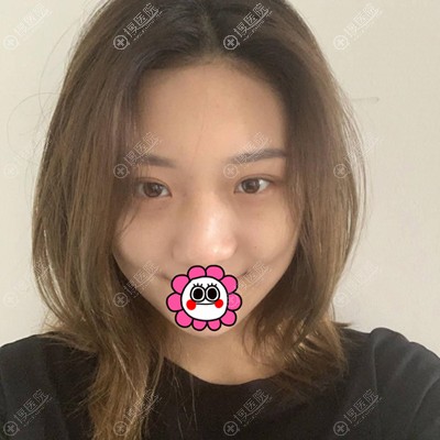 从平凡到美女只因我在蚌埠美莱坞找张迪做了假体隆鼻