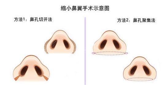 缩小鼻翼手术示意图 缩小鼻翼手术示意图