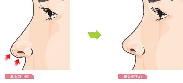 鼻头缩小前后对比效果 鼻头缩小前后对比效果
