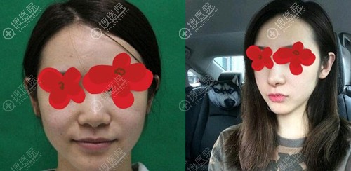 烟台鹏爱魏璐假体隆鼻案例 烟台鹏爱魏璐假体隆鼻案例