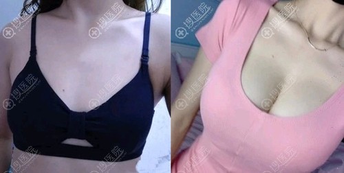 烟台鹏爱魏璐假体隆胸效果图 烟台鹏爱魏璐假体隆胸效果图