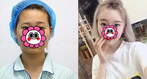 面部脂肪填充过量修复效果对比 面部脂肪填充过量修复效果对比