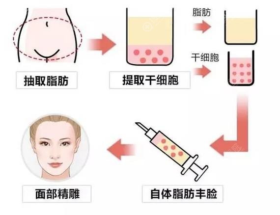 面部脂肪填充示意图 面部脂肪填充示意图