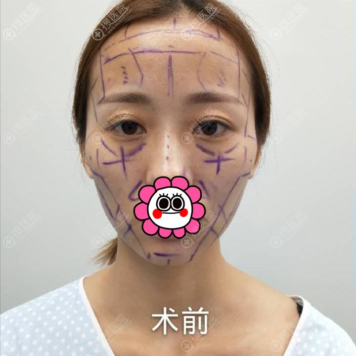 我这张瘦的大长脸居然在长沙协雅用自体脂肪填充修饰了脸型