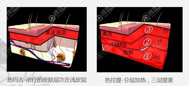 热拉提和热玛吉的区别 热拉提和热玛吉的区别